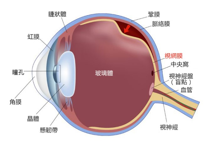 視網膜脫落時眼球的構造示意圖